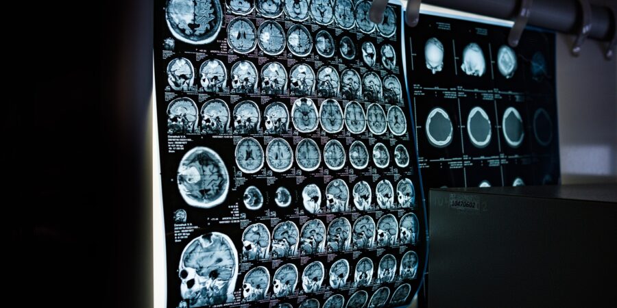 X-ray or MRI scans of a patient's brain hanging over a backlight for a doctor to evaluate.